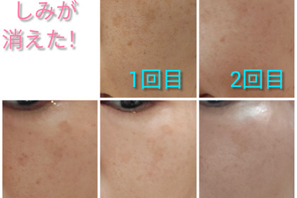 越谷　美容室　美容院　liage　シミ取り　美肌　しみ　シミ取り