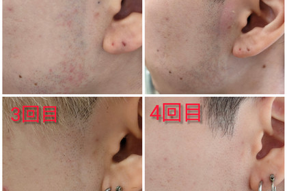 越谷　美容室　美容院　liage　COTA  脱毛　髭脱毛　もみあげ脱毛　ヒゲ脱毛