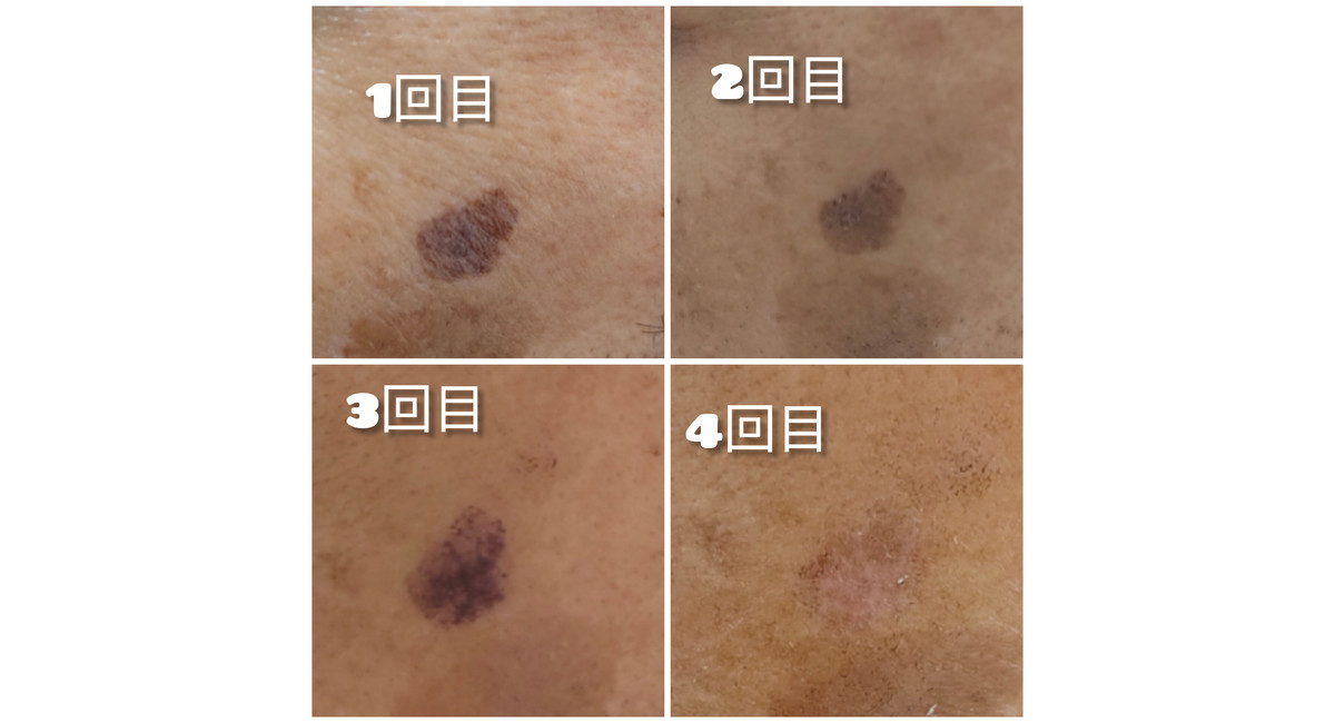 越谷　美容室　美容院　liage　シミ改善　シミケア　しみ　シミ取り