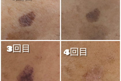 越谷　美容室　美容院　liage　シミ改善　シミケア　しみ　シミ取り
